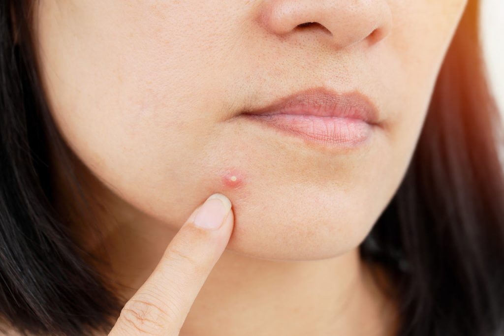 acne-no-rosto-voc-pode-estar-contribuindo-para-o-problema