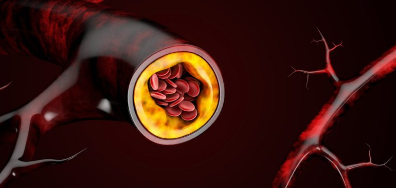 Colesterol alto: 5 doenças graves causadas pelo problema