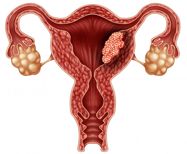 o câncer cervical, ou de colo de útero, é um dos tipos mais comuns que atingem as mulheres