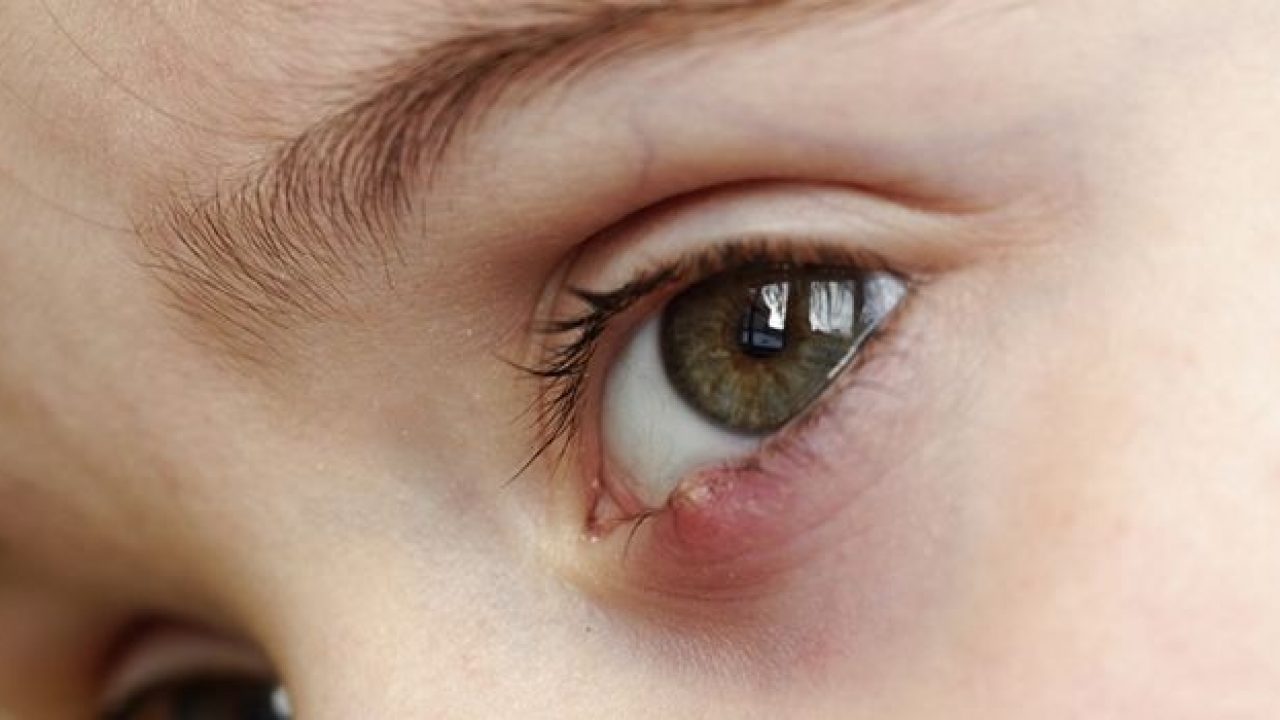 Hordéolo ou Terçolho no olho - o que é, causas, tratamento, cura